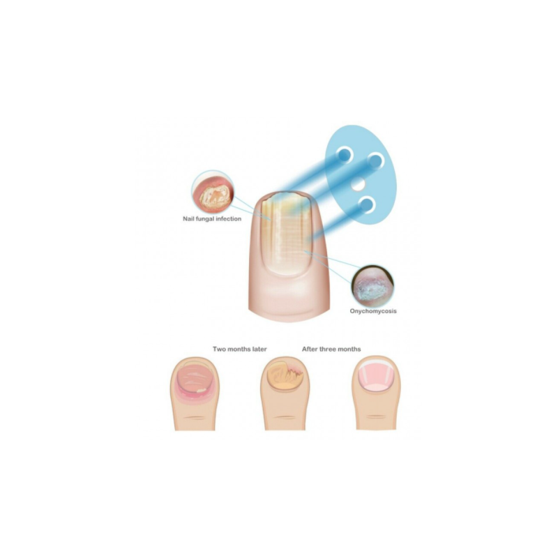 Tragbarer Laser für Nagelerkrankungen...