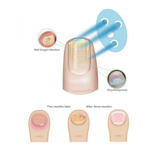 Tragbarer Laser für Nagelerkrankungen RK 6000 FL